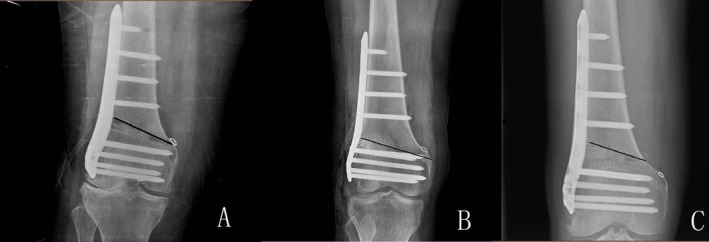 Analysis of Intraoperative and Postoperative Hinge Fractures of Patients With Genu Valgum Treated With Lateral Open Wedge Distal Femoral Osteotomy.