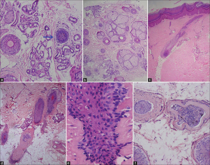A Brief Review of Scalp Biopsy and its Interpretation.