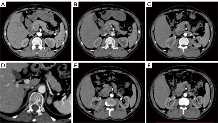Dual-layer spectral detector computed tomography for adrenal adenoma characterization: radiation dose reduction and quantitative agreement of multiphase virtual noncontrast with true noncontrast imaging.