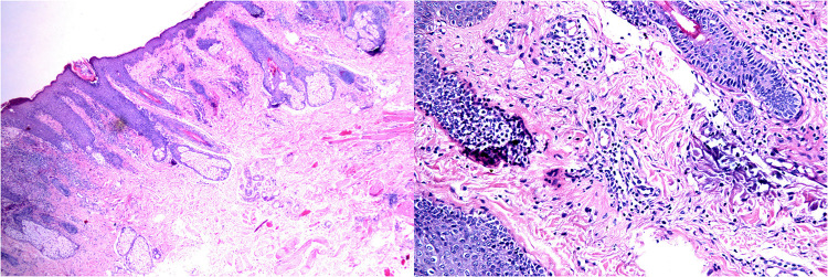 <i>Naganishia albidus</i> Causing Perioral Cutaneous Infection: A Rare Case Easily Misdiagnosed.