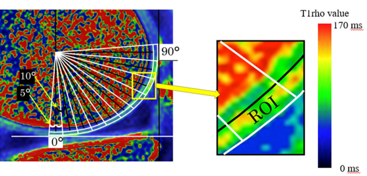 Evaluation of Cartilage Degeneration Using MRI T1ρ Mapping after Locomotion Training in Patients with Early Knee Osteoarthritis.