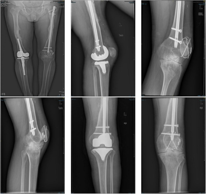 Total knee arthroplasty for ankylosed knees in the extended position with hemophilia: a medium- and long-term single-center experience.