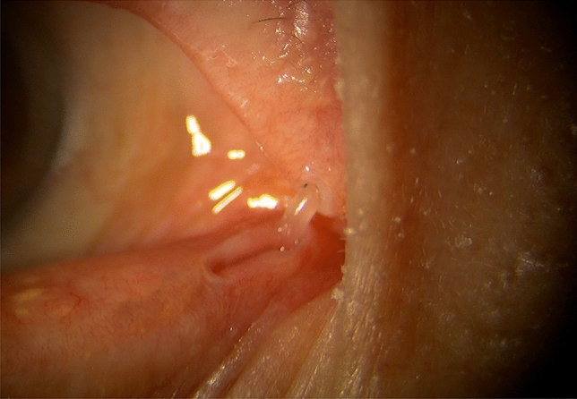 Dacryoendoscopy as a frontier technology for lacrimal drainage disorders.