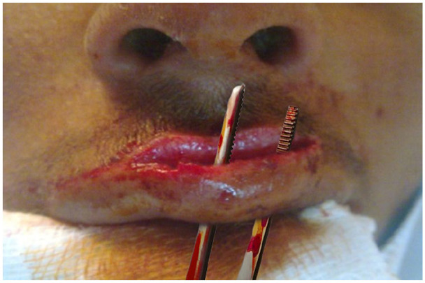 Beyond Sutures: Moist Exposed Burn Ointment (MEBO) and Scar Massage for Anatomical Restoration of Penetrating Upper Lip Laceration at the Vermilion-Cutaneous Junction in Primary Care-A Case Report.