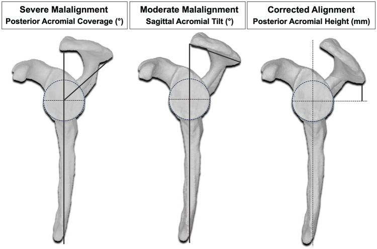 Posterior Shoulder Stability Can Be Restored by Posterior Acromial Bone Grafting (Scapinelli) in a Cadaveric Biomechanical Model With Normal Glenoid Anatomy.