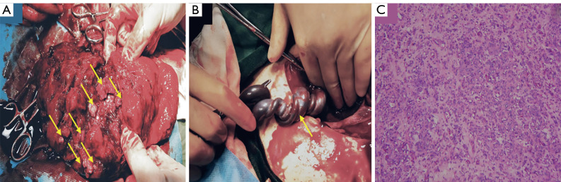 Prenatal ultrasound diagnosis of a rare diffuse placental chorioangioma with fetal edema: a case description and prognostic analysis.