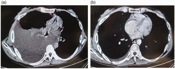 Management of chylous pleural and peritoneal effusions in a cirrhotic patient: A case report and review of literature.