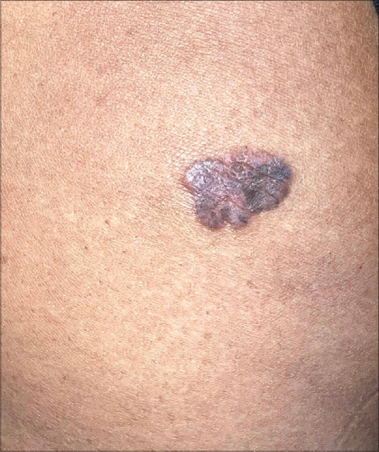 Dermoscopy and Ultraviolet Reflectance Dermoscopy of Benign Lichenoid Keratosis Masquerading as Melanoma.