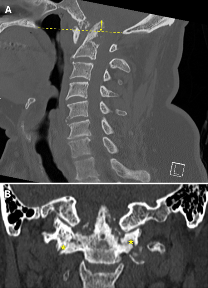 CPPD-related basilar impression with vertebral artery dissection and subsequent subarachnoid hemorrhage: illustrative case.