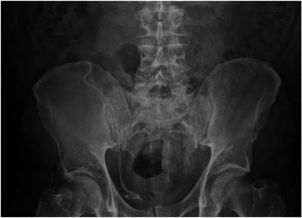 Nineteen-year forgotten ureteral stent removed under local anaesthetic from a transplanted kidney.