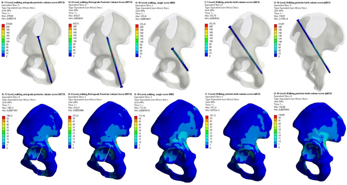 Is the innovative both column screw fixation technique a biomechanical game-changer in the fixation of acetabular posterior column fractures?