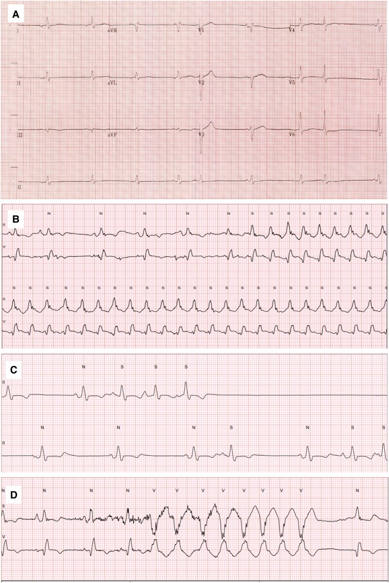 Long-term hydroxychloroquine use resulting in cardiomyopathy and conduction abnormalities: a case report.