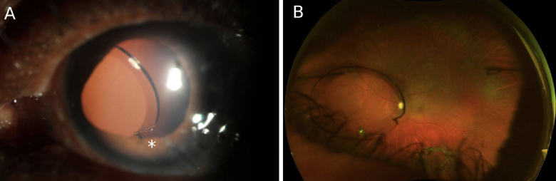 Haptic-Optic Fractures in Yamane Flanged Intrascleral Fixated Lenses: A Case Series.