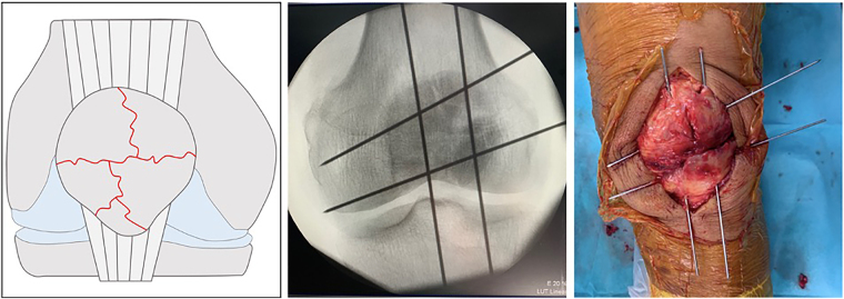 The 'hashtag' K-wires configuration for the management of severe comminuted patellar fracture: the combination of tension band technique and cerclage wiring.
