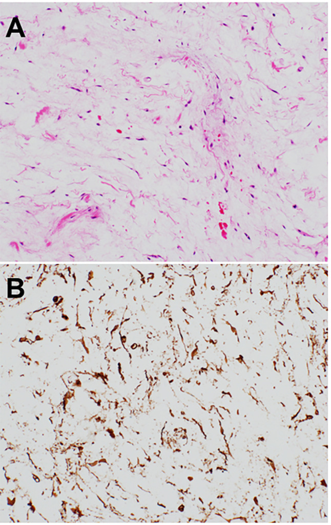 Superficial Angiomyxoma Revisited.