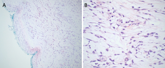 Myxoid spindle cell neoplasm with FET::CREB fusion mimicking meningioma: illustrative case.