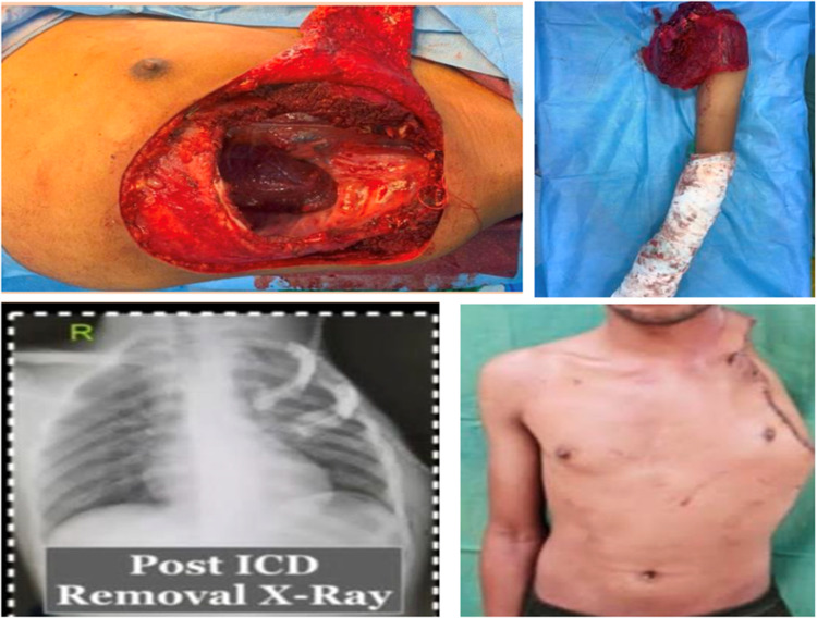 Short-term outcomes of chest wall resections.