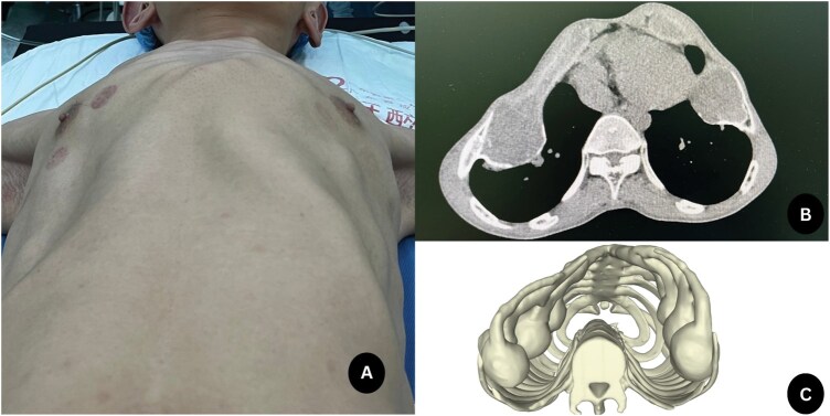 Secondary Asphyxiating Thoracic Dysplasia Due to Multiple Chondromas: A Novel Surgical Report.