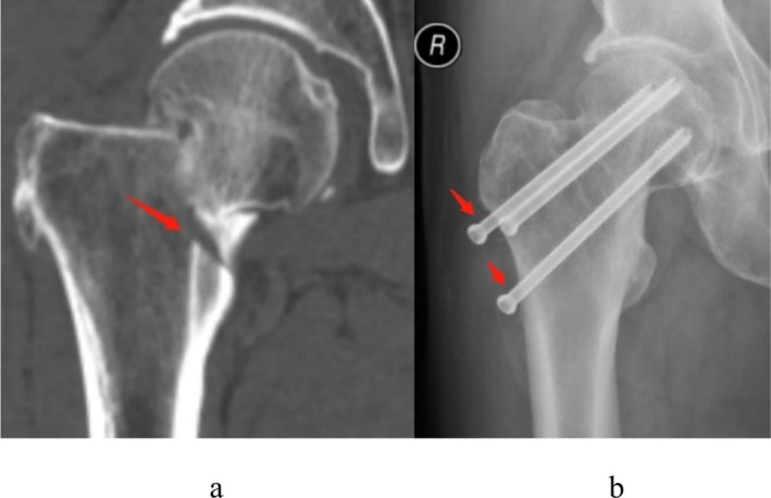 A Retrospective Study on the Relationship Between Calcar Femorale Injury and Postoperative Complications of Femoral Neck Fracture in Young and Middle-Aged Patients Treated With Three Cannulated Screws.