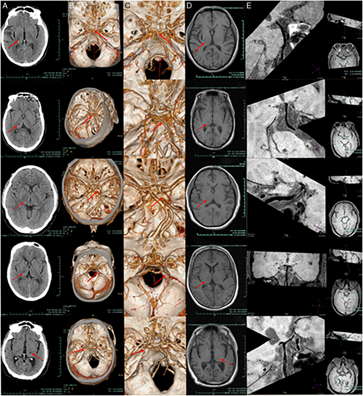 Clinical and Imaging Characteristics of Thalamic Infarction Combined With Moderate-to-Severe Stenosis of the Posterior Cerebral Artery: A Single-Center Experience.