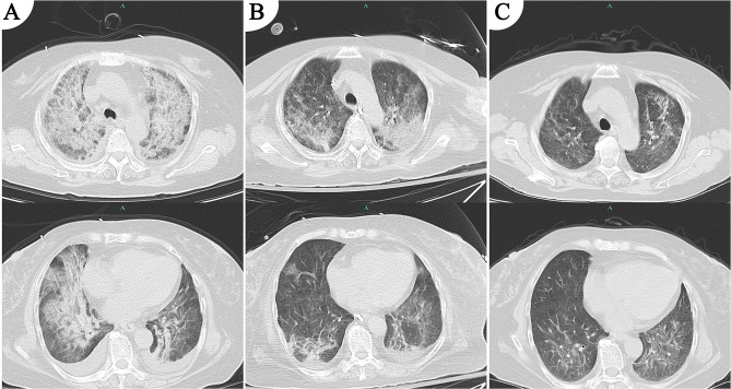 Diagnostic Challenges of Six-Pathogen Detected by mNGS in an Immunocompromised ICU Patient with Severe Community-Acquired Pneumonia-Induced Sepsis: A Case Report and Literature Review.