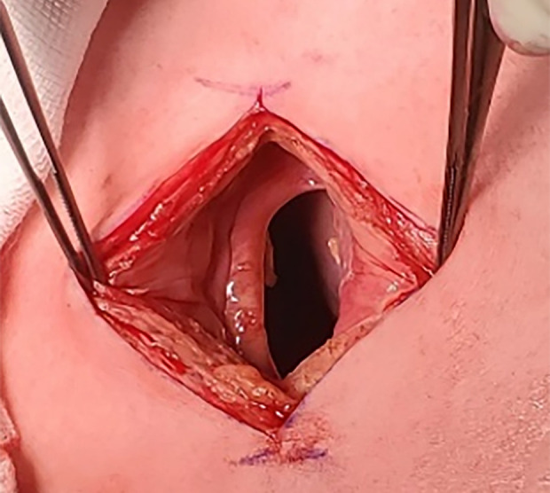 Postoperative Residual Pleural Space: A Risk Factor for Chest Wall Hernia After Thoracoscopic Surgery.