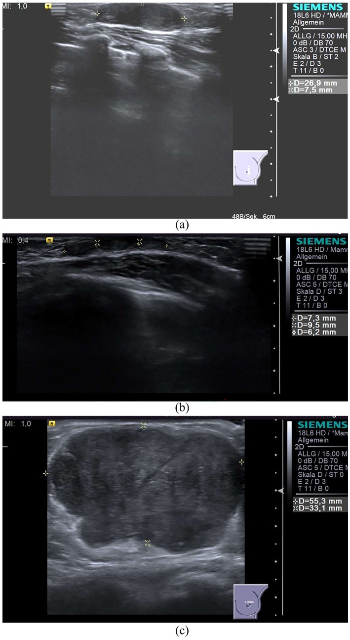 Juvenile Fibroadenoma Detected at 2 Years and Rapid Growth at Thelarche: Case Report and Literature Review.