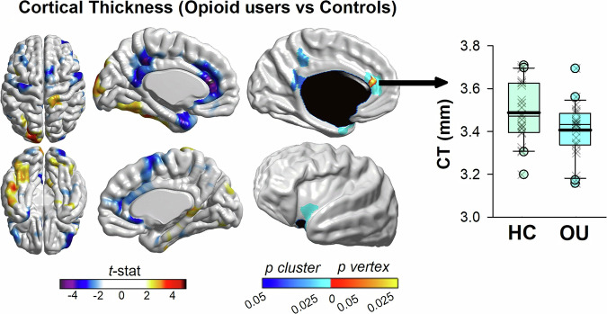 Blunted anterior midcingulate response to reward in opioid users is normalized by prefrontal transcranial magnetic stimulation.