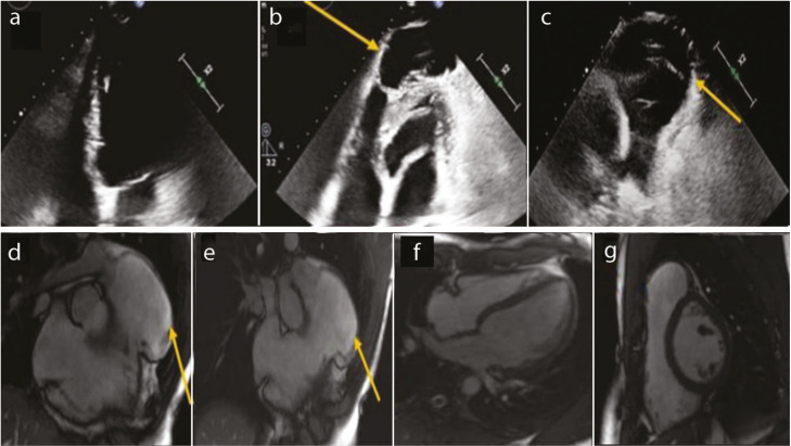 Differentiating Pectus Excavatum-Related Right Ventricul Dysfunction from ARVD: The Role of Cardiac Imaging