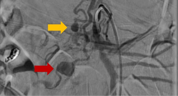 Unveiling the unexpected: spontaneous ruptured pancreaticoduodenal artery pseudoaneurysm with retroperitoneal hematoma requiring pancreaticoduodenectomy.