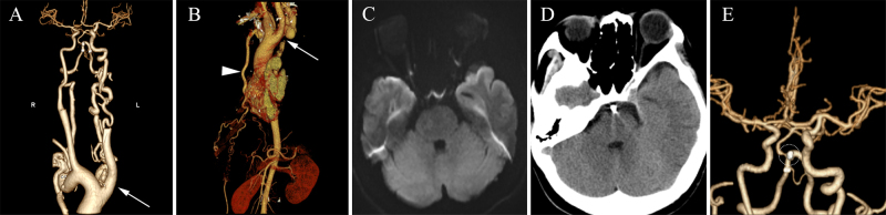 Ruptured vertebrobasilar junction aneurysm coexisting with isolated interrupted aortic arch and basilar artery hypoplasia in an adult female: illustrative case.