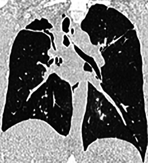 Exploring lung cavity access to endobronchial valve in chronic pulmonary aspergillosis and nontuberculosis mycobacterial diseases, a radiological feasibility study.