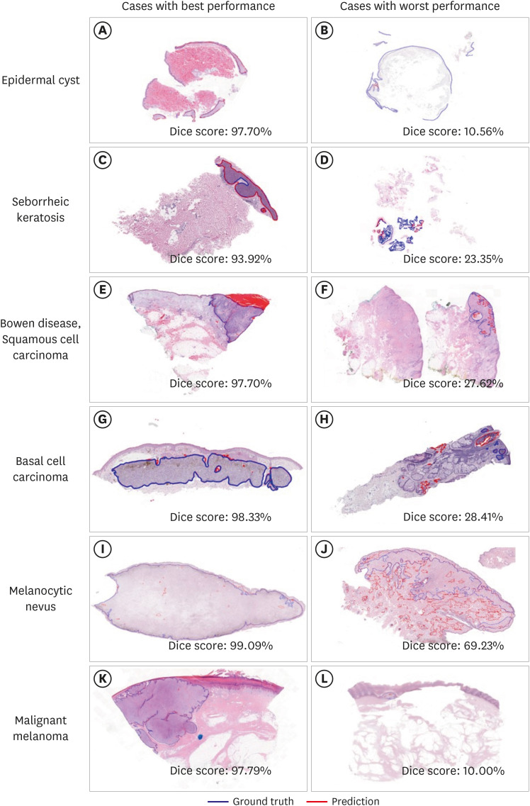Large-Scale Dermatopathology Dataset for Lesion Segmentation: Model Development and Analysis.