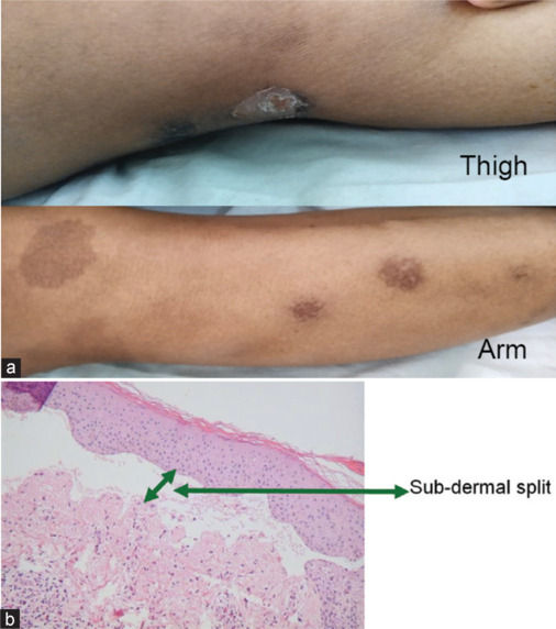 A case series of vildagliptin-associated bullous pemphigoid - Rare side effect.