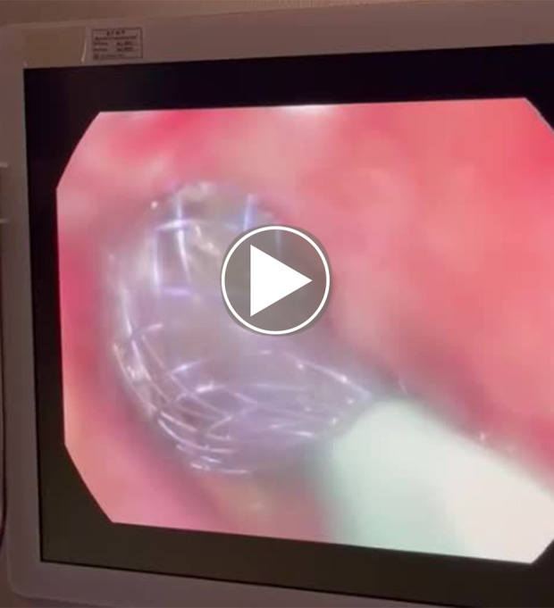 Innovative Use of Atrial Septal Defect Occluders for Gastric Leak Management After Sleeve Gastrectomy: A Case Report.