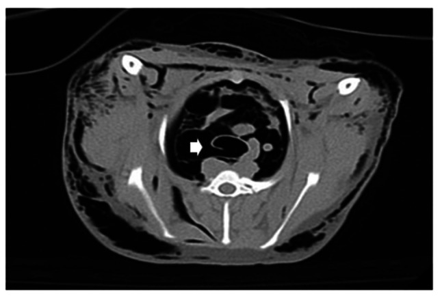 Tracheal Reconstruction Using a Nitinol Stent for Thoracic Tracheal Rupture.