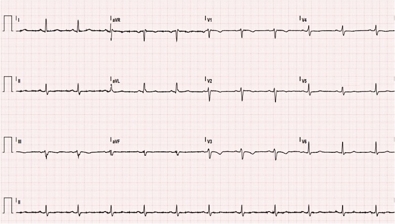 When chest pain is not what it seems: time for right diagnosis and right treatment-a case report.