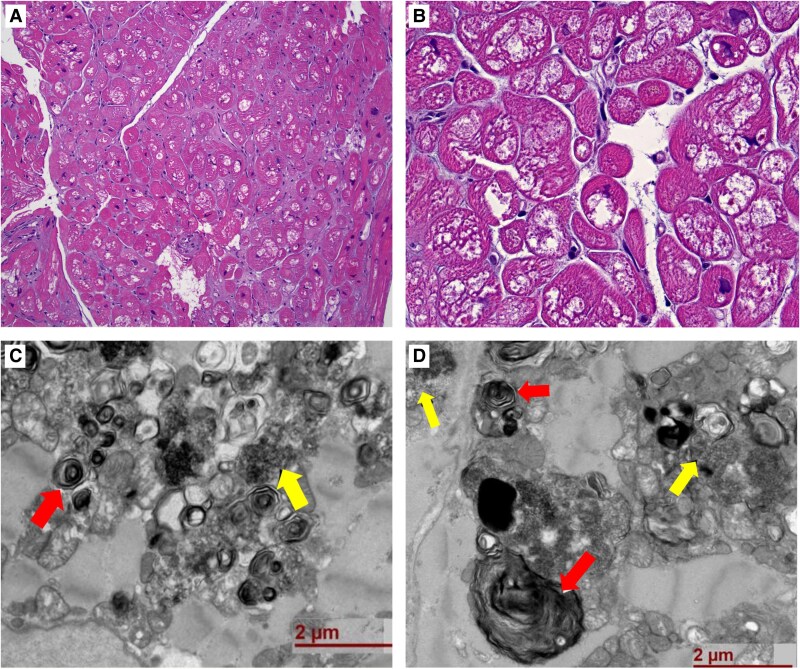 Long-term hydroxychloroquine use resulting in cardiomyopathy and conduction abnormalities: a case report.