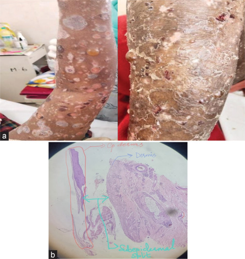 A case series of vildagliptin-associated bullous pemphigoid - Rare side effect.