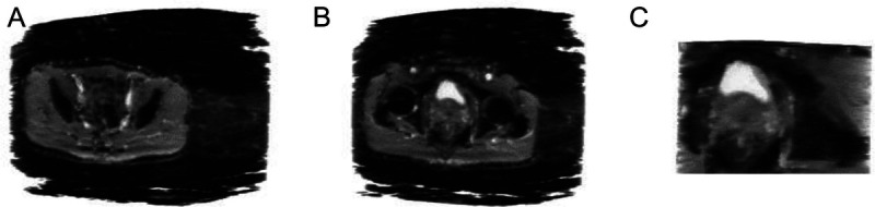 Computer-aided diagnosis based on 3D deep convolutional neural network system using novel 3D magnetic resonance imaging sequences for high-grade prostate cancer.