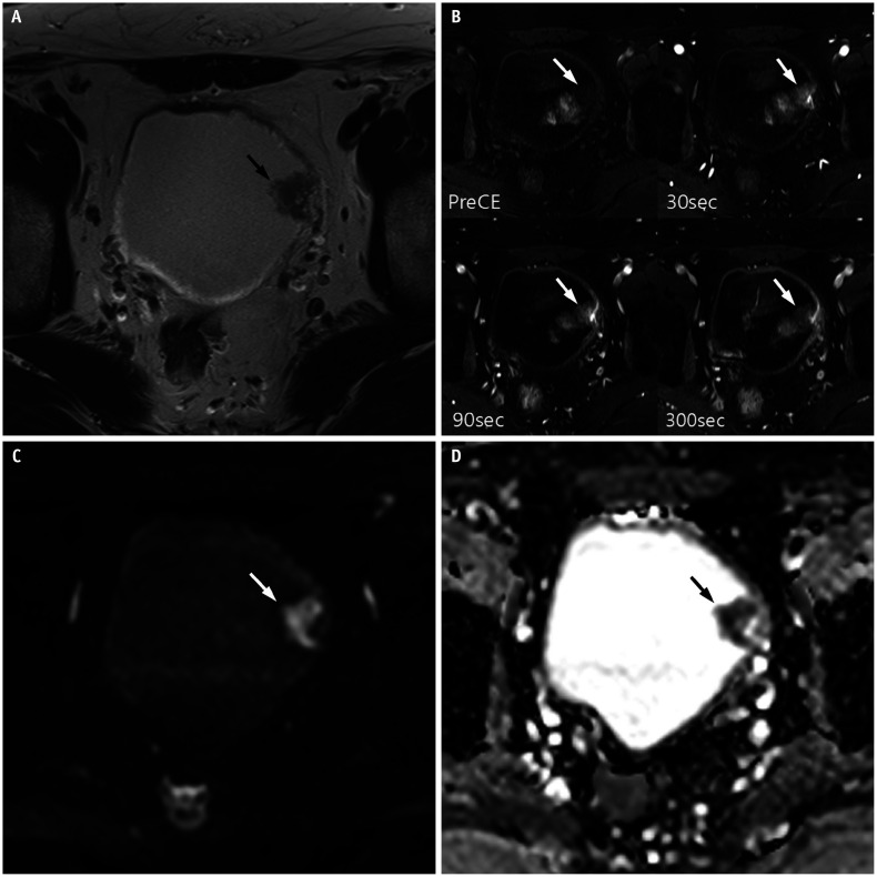 Multiparametric MRI Features of Plasmacytoid Urothelial Carcinoma of the Urinary Bladder.