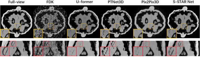 Sliding volume-based streak artifact reduction network (S-STAR Net) for ultra-sparse-view computed tomography.