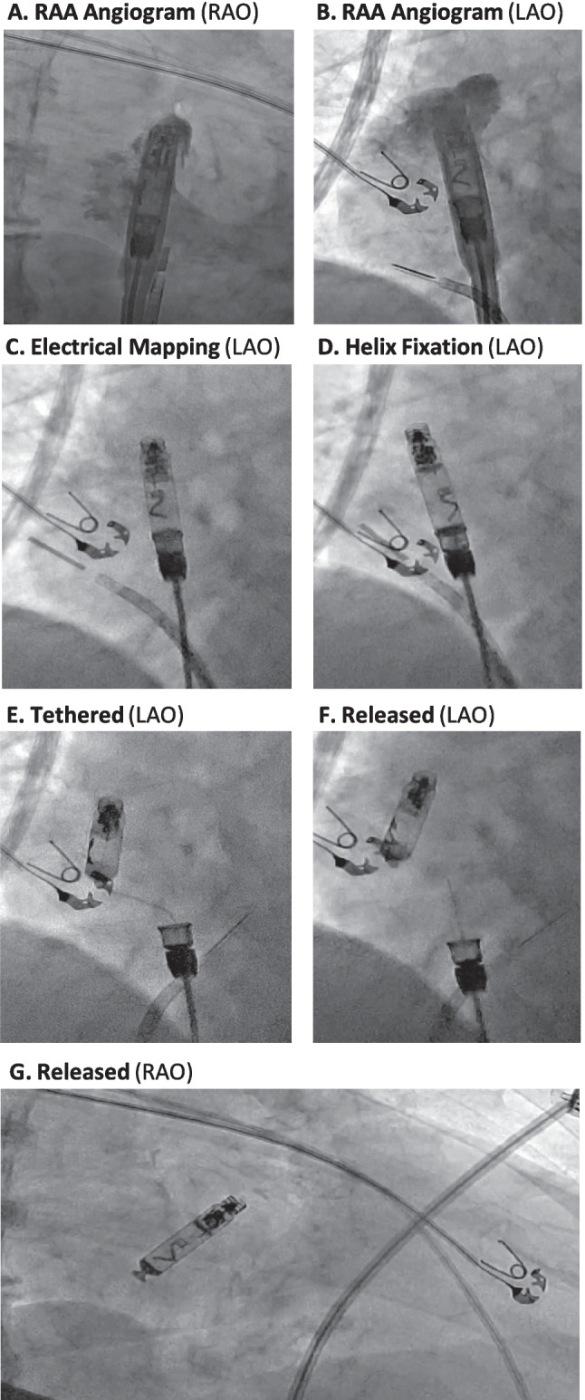 Atrial helix-fixation leadless pacemaker: real-world single-chamber implant experience.