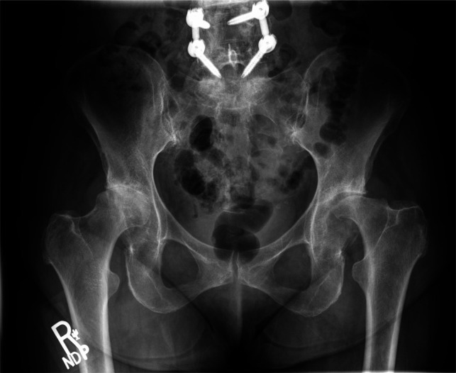 Bilateral Osteonecrosis of the Femoral Head and Proximal Femur After Corticosteroid Injections: A Case Report.