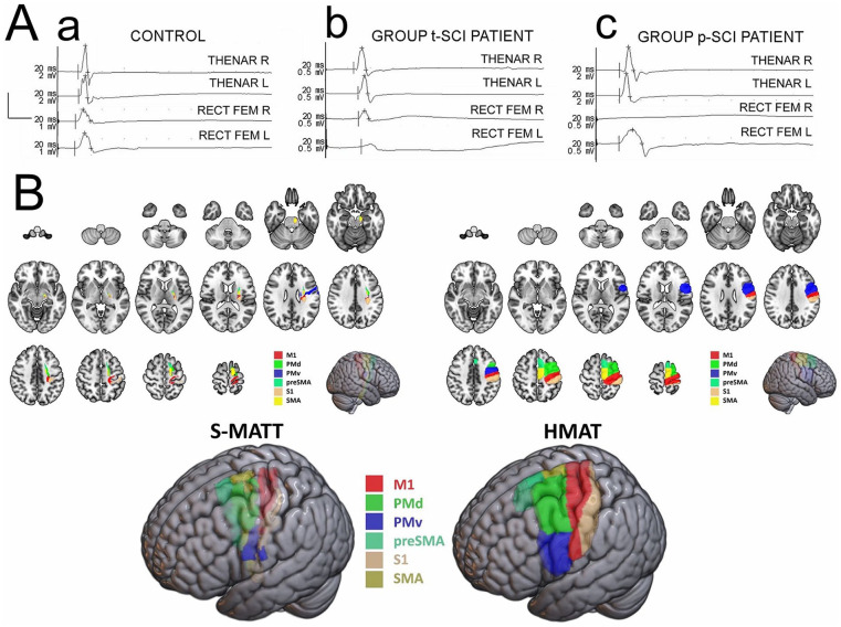 Diffusion Tensor Imaging Findings in Cerebral Sensorimotor Areas in Patients After Spinal Cord Injury Correlate With Neurophysiological Deficits.