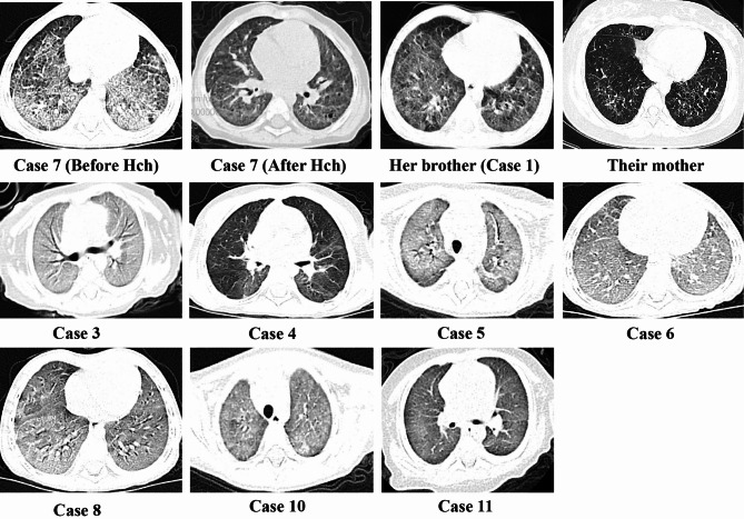 Clinical characteristics of SFTPC gene mutations in children: a single-center experience.