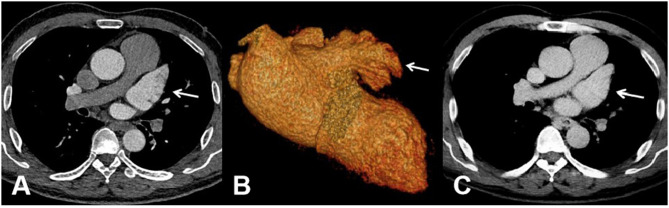 The Imaging Evaluation of Left Atrial Appendage: CT Large-Spiral Arterial Late Scan.