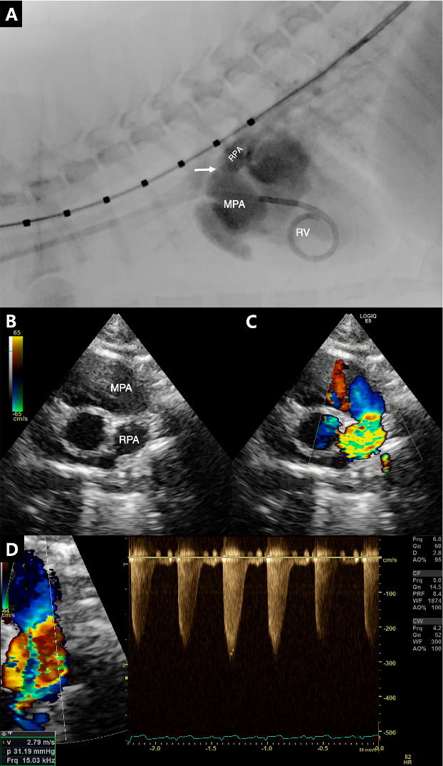 Successful balloon angioplasty of right pulmonary coarctation with left pulmonary artery interruption in a cat: a long-term outcome follow-up case report.