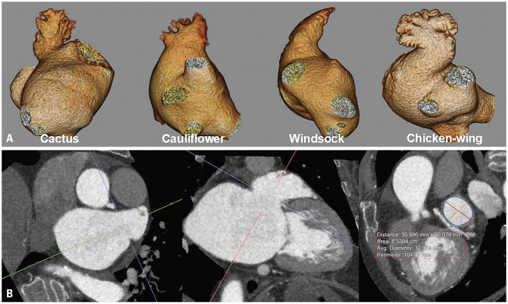 Left Atrial Appendage Characteristics Assessed with Cardiac Computed Tomography in Patients with Atrial Fibrillation and Severe Mitral Valve Disease.