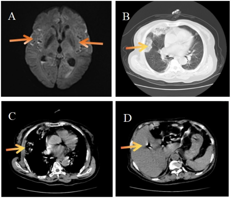 Cerebrospinal Fluid Exchange Combined with Intrathecal Antibiotic Injection for the Management of Severe Intracranial Infection Caused by Hypervirulent <i>Klebsiella pneumoniae</i>: A Case Report.